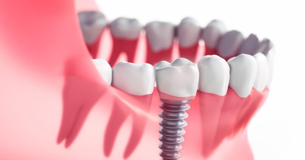 dental implants dentures