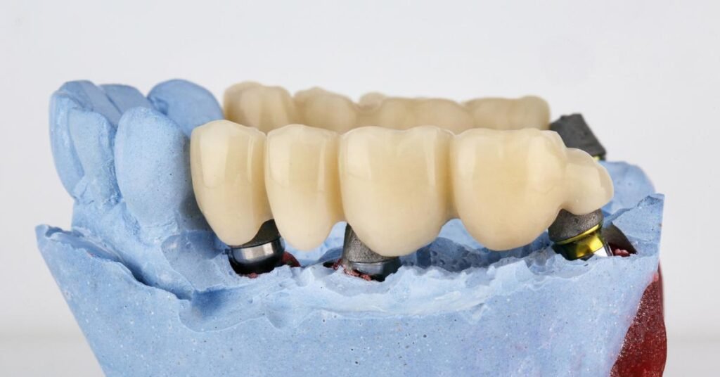 dental bridges consultation