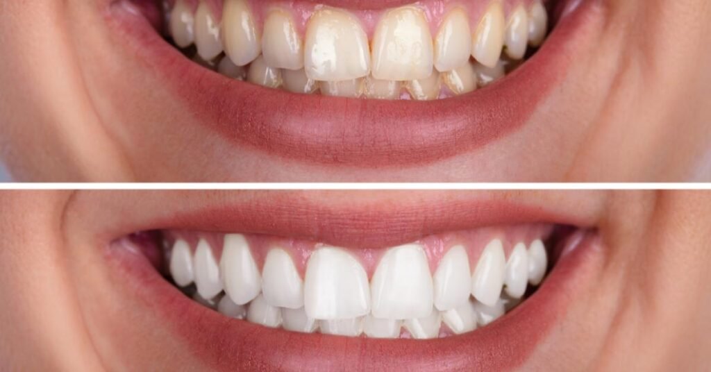 Invisalign before and after