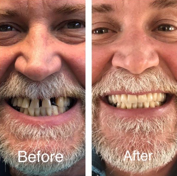 Before and after partial dentures