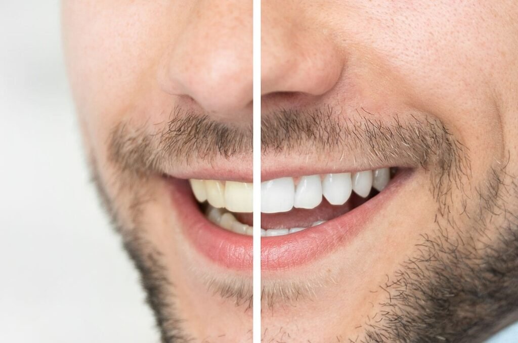 How Long Does Teeth Whitening Last