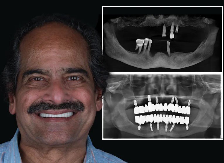 Pictures of dentures that look real