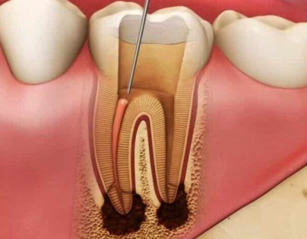 Root canal cost Toronto