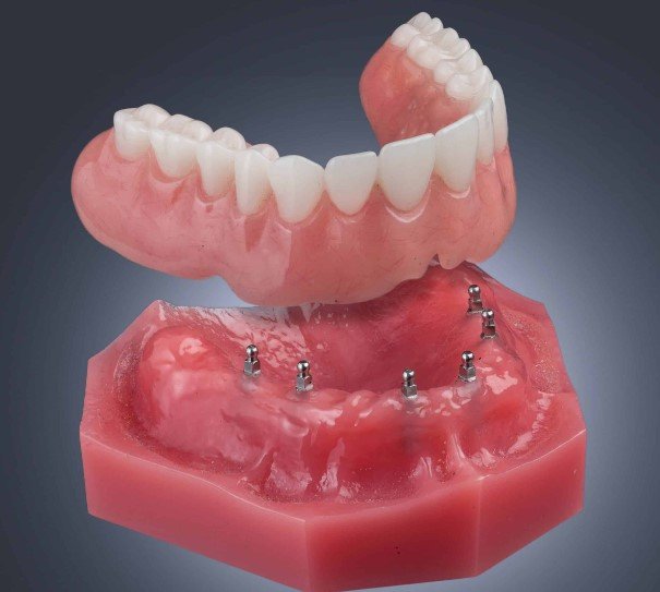 Cost Implant Dentures