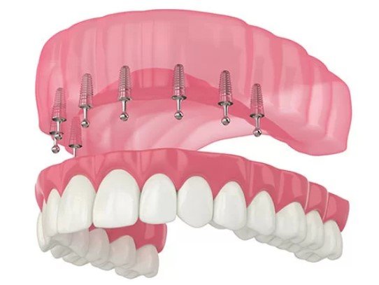 how much are snap in dentures