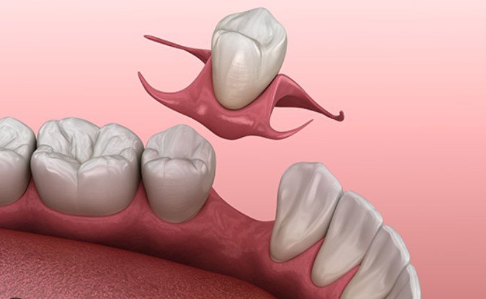 one tooth partial denture