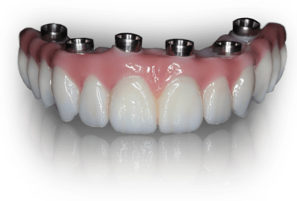 Hybrid implant denture
