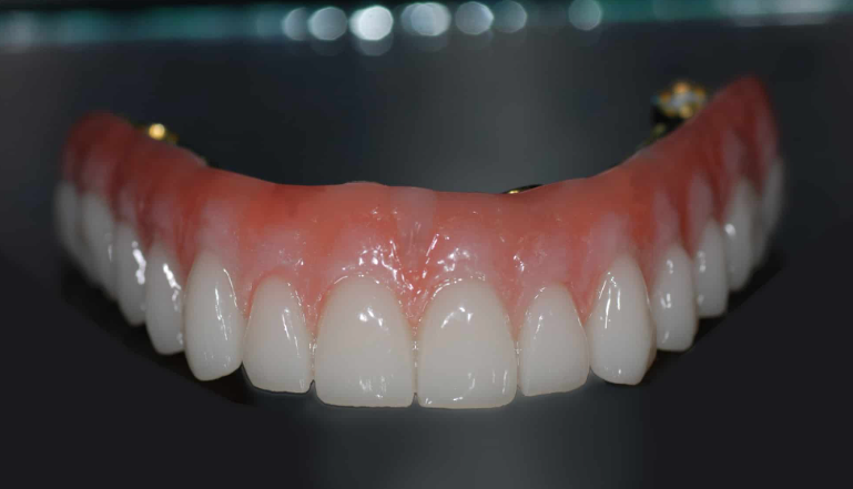 Hybrid Denture Cost