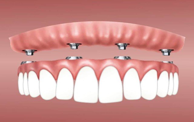 Problems With Snap in Dentures