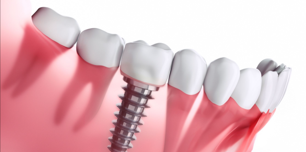 Cost of Dental Implants in Ontario