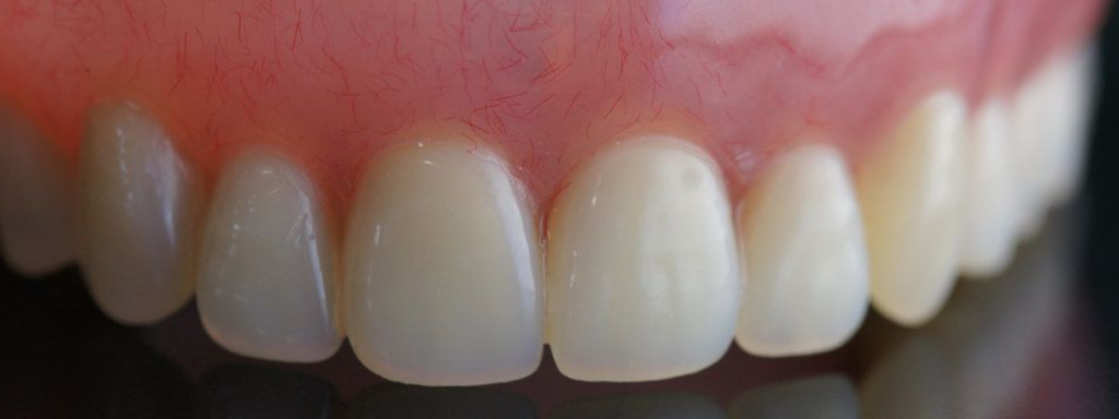 Full Mouth Extraction Immediate Dentures Pictures