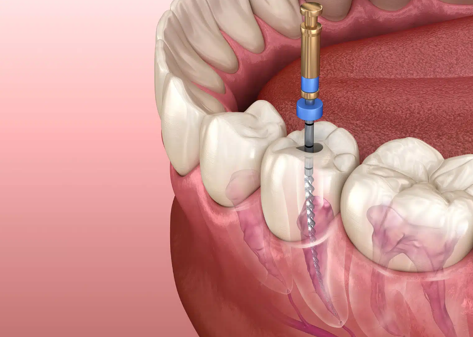 How do i know if i need a root canal?