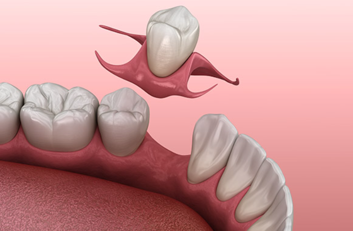 Front tooth denture
