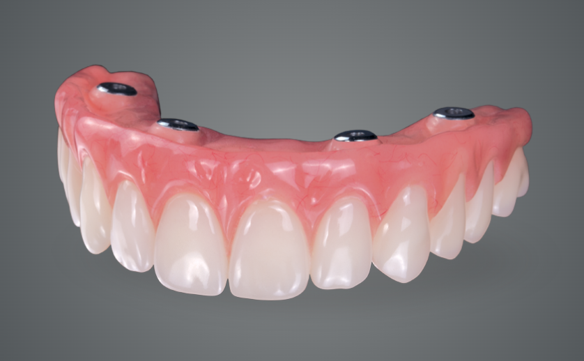 What Is A Hybrid Denture