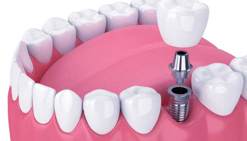 Dental implant charges