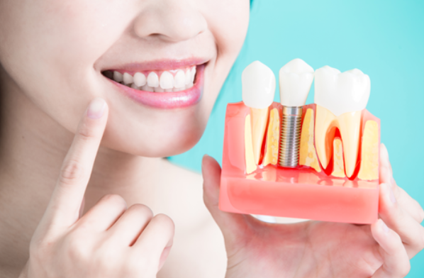 Dental implants Toronto