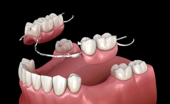 How long do partial dentures last?