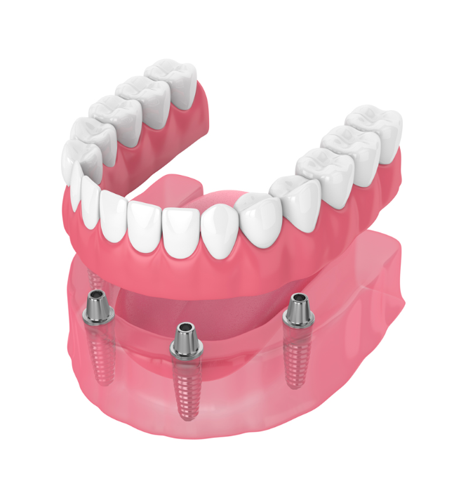 How long should dentures last?