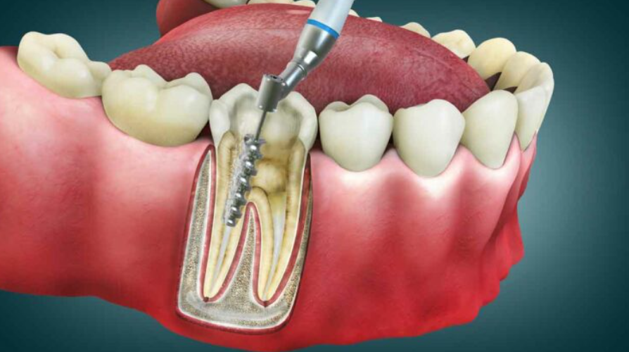 How much does a root canal cost?