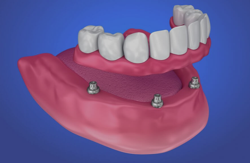 Implant Dentures Price