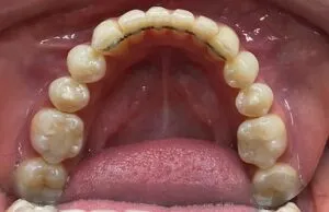 After image